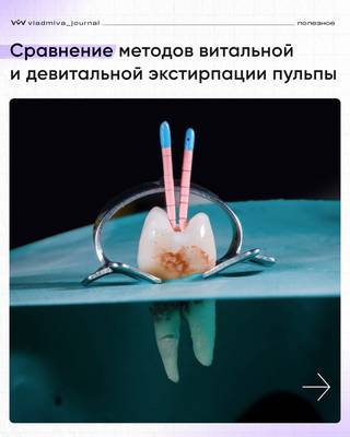 Витальная и девитальная экстирпация — два подхода к удалению пульпы.